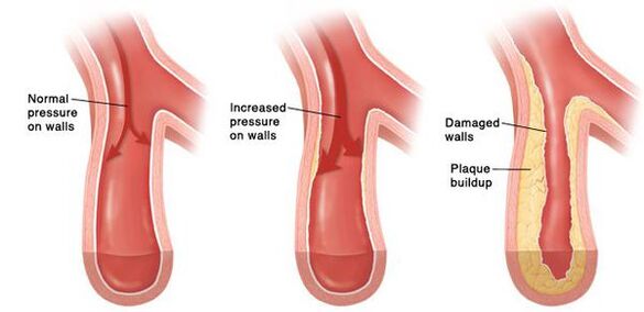 Hipertansiyonda damar yatağının açıklığının ihlali söz konusudur